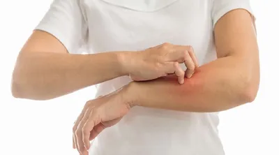 سبق اخبار اليمن الان الحساسية حروق الشمس الأمراض الجلدية اخبار اليمن الان الحدث اليوم عاجل سبق