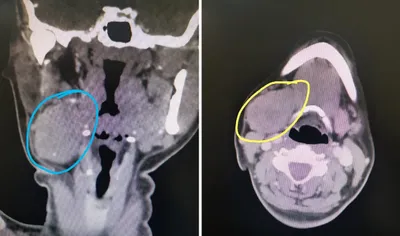 سبق اخبار اليمن الان عملية دقيقة لاستئصال الغدة السفلي اخبار اليمن الان الحدث اليوم عاجل سبق