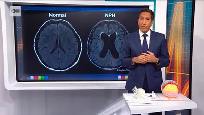 cnn عربي اخبار اليمن الان المغني باضطراب دماغي استسقاء الرأس اخبار اليمن الان الحدث اليوم عاجل cnn عربي