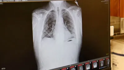 سبق اخبار اليمن الان الهواء الملوث لإصابات سرطان المدخنين اخبار اليمن الان الحدث اليوم عاجل سبق